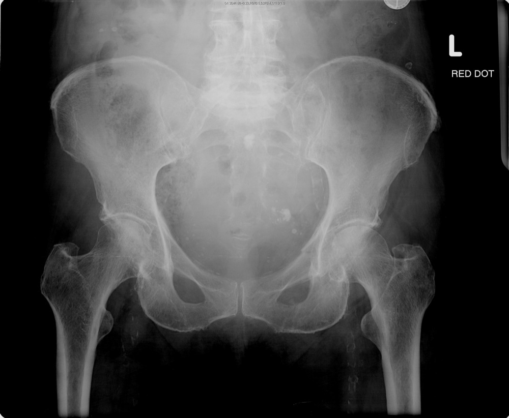 Spinal Spinal Enthesopathy